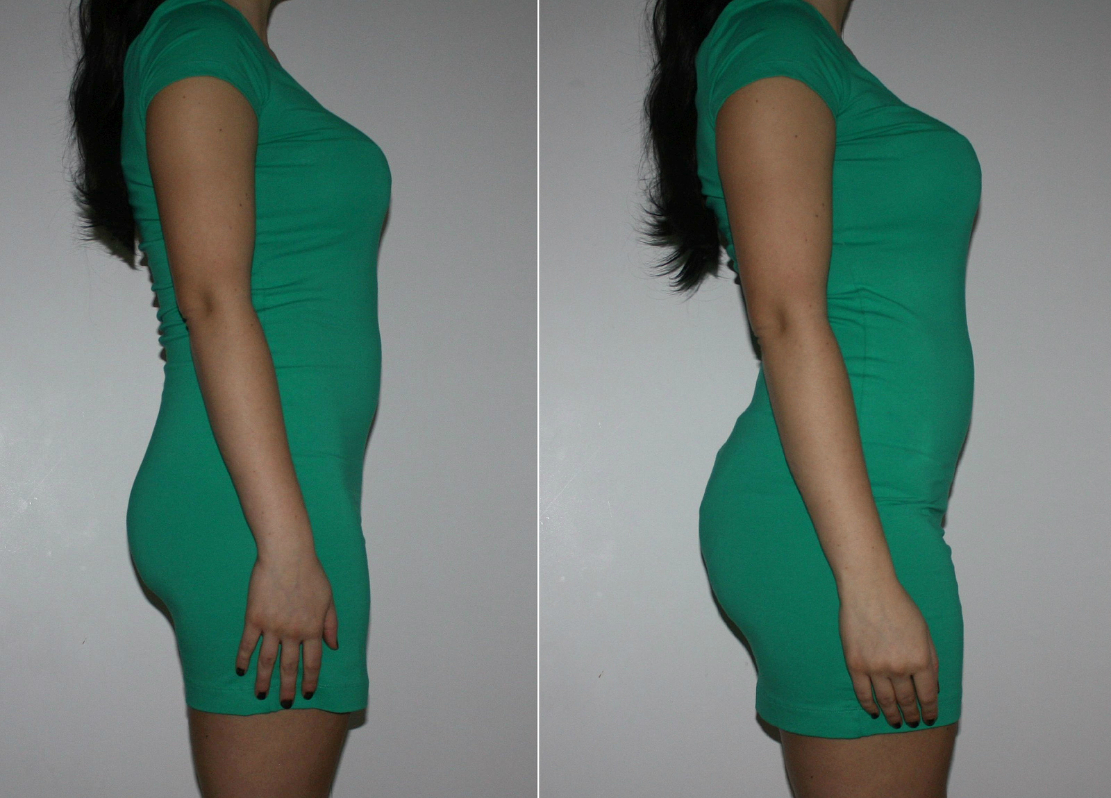 How Long Do Results Last After a Non-Surgical BBL?